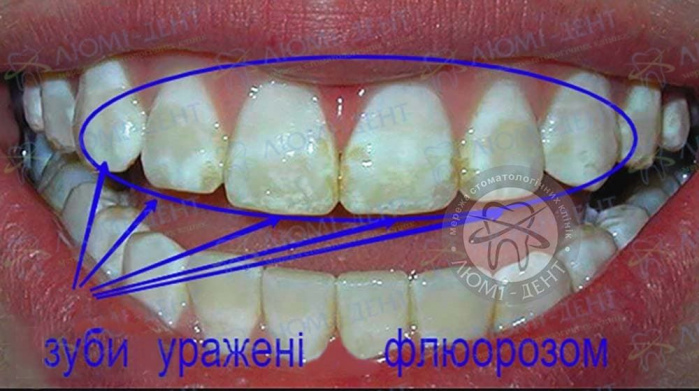 Флюороз зубів емалі фото Люмі-Дент